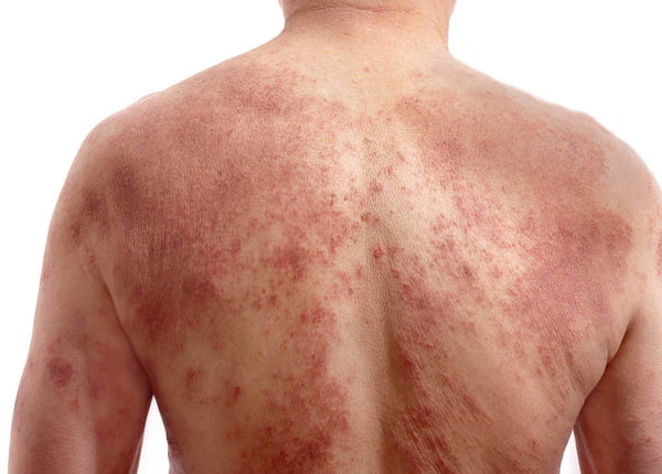 Лямблии - симптомы высыпи на спине человека