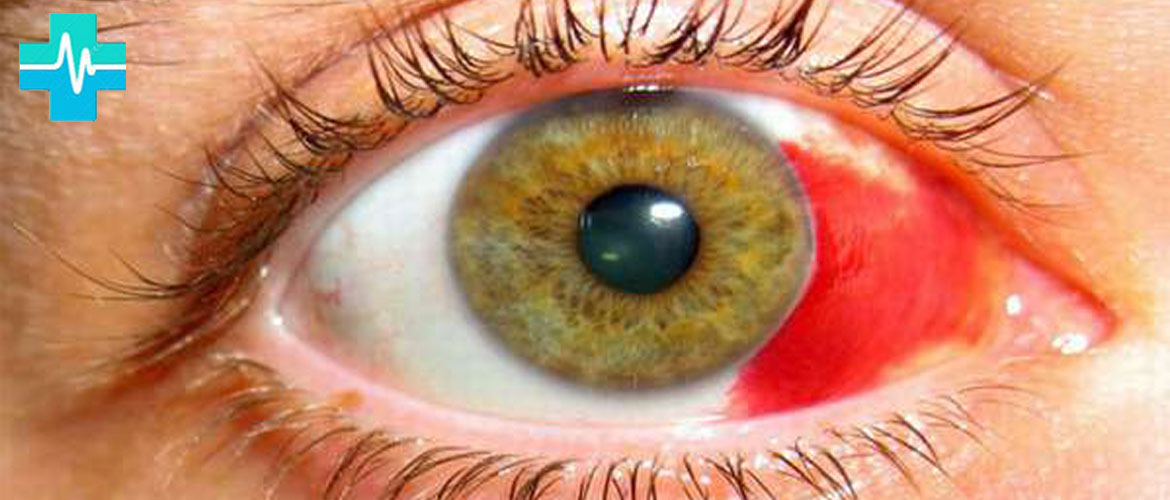 Кровоизлияние в глаз: лечение, причины и последствия - на gemoparazit.ru