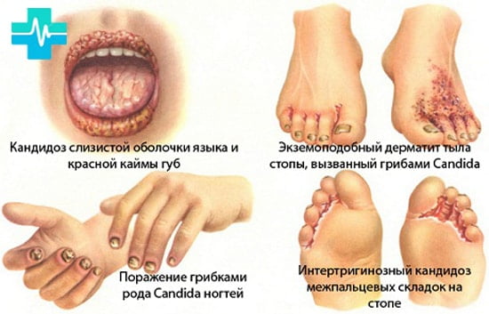 Схема лечения кандидоза кожи