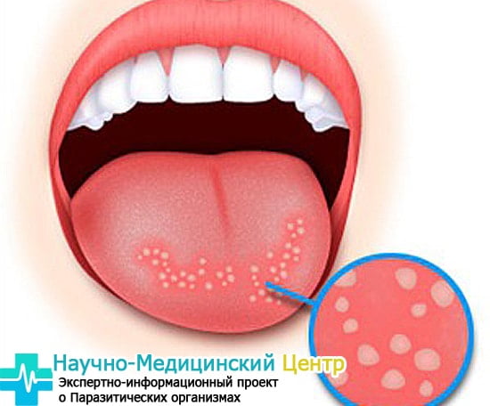 Наружное лечение кандидоза полости рта