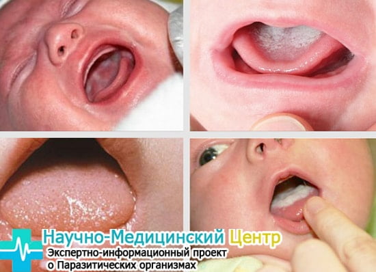 Принципы лечения кандидоза полости рта