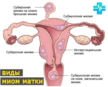 Лейомиома матки с геморрагическим синдромом