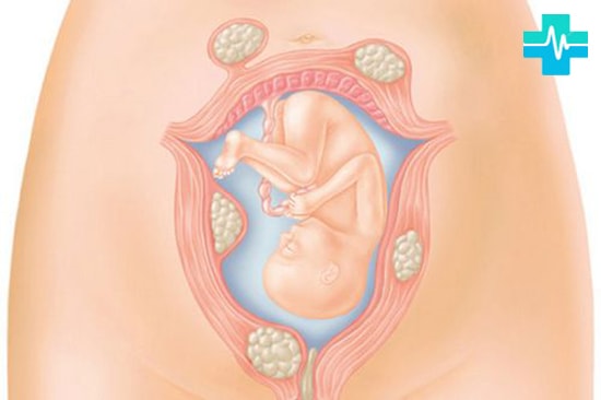 Лейомиома матки с геморрагическим синдромом thumbnail