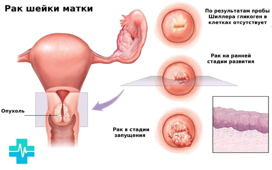 Лейомиома матки с геморрагическим синдромом