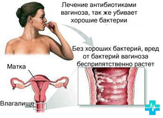 Как вылечить инфекцию у женщины