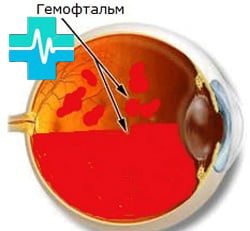 Гемофтальм - рисунок на gemoparazit.ru