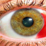 Кровоизлияние в глаз: лечение, причины и последствия - на gemoparazit.ru