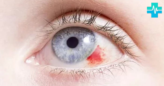 Кровоизлияние в глаз - фото на gemoparazit.ru