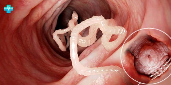 червь прицепился к стенкам кишечника человека- картинка на gemoparazit.ru
