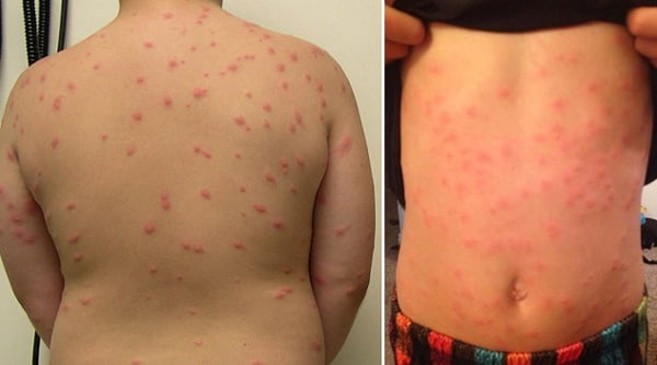 Шистосомный дерматит на коже спины и живота